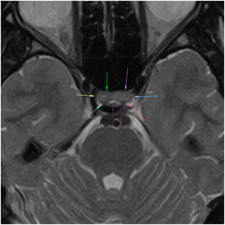 Наглядное фото МРТ гипофиза мозга